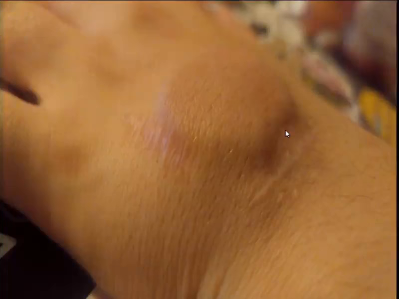 The back of someone's hand, showing a large bulge where an implant has been placed. Along one side of the bulge at left is visible an older healed scar, with another newer one also visible along a different side.